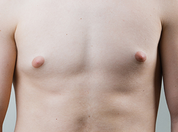 Enlarged Breasts in Men
