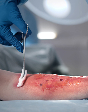 Burns Reconstructive Image