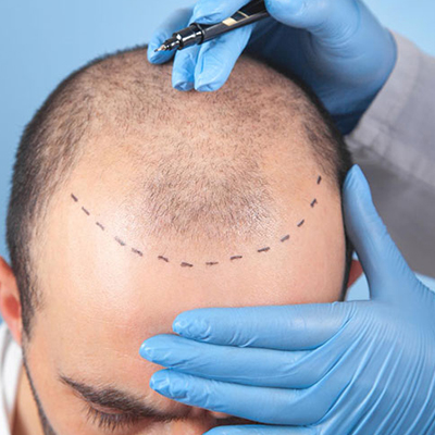 Hair Transplant in Guntur